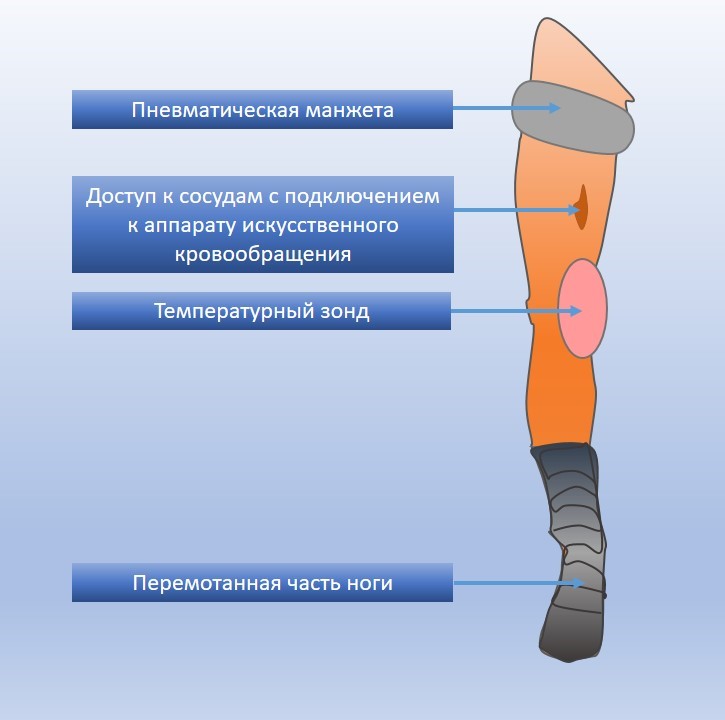 Изолированная перфузия конечностей (ИПК) при локально прогрессирующих или рецидивирующих саркомах мягких тканей