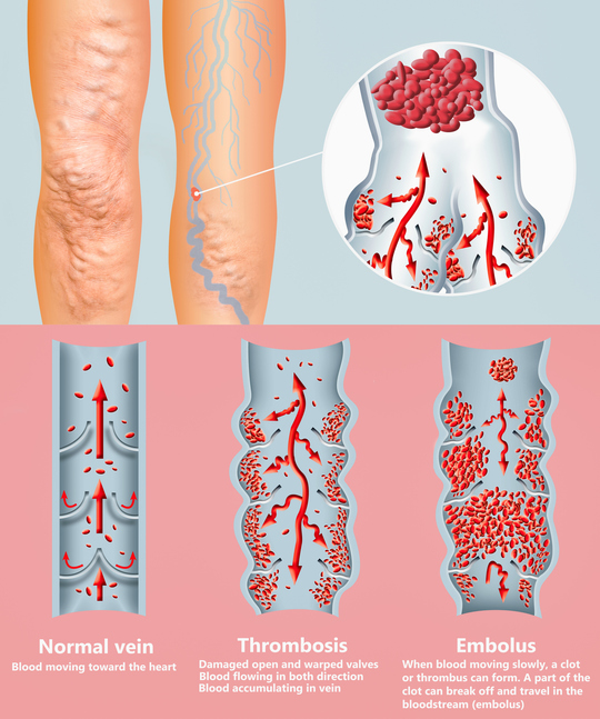 Тромбоз вен. Лечение и диагностика тромбоза нижних конечностей в клинике ЕМС