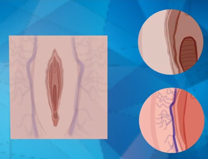 Лечение декубитальной язвы у женщин при выпадении тазовых органов