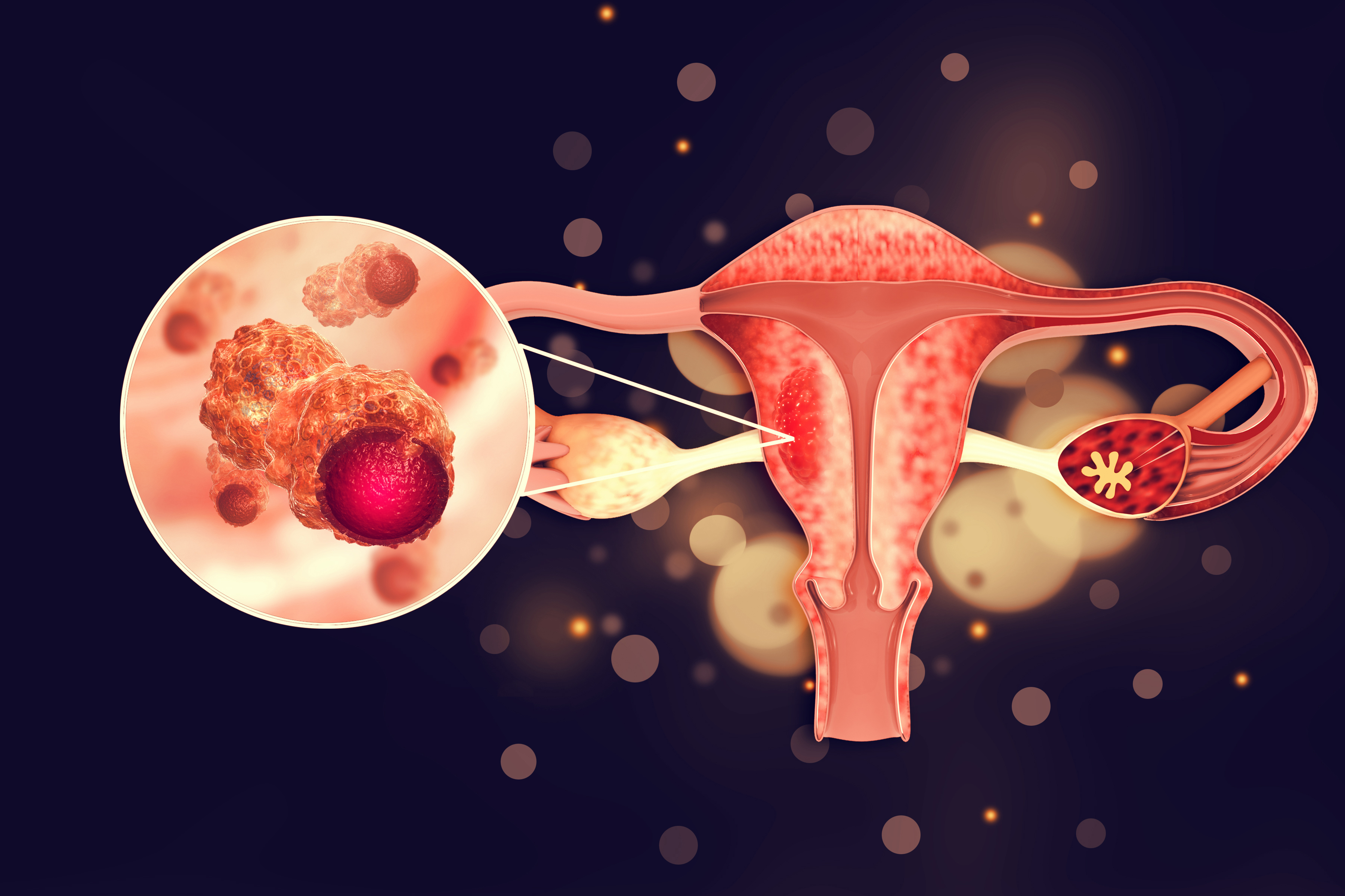 Виды и стадии рака яичников