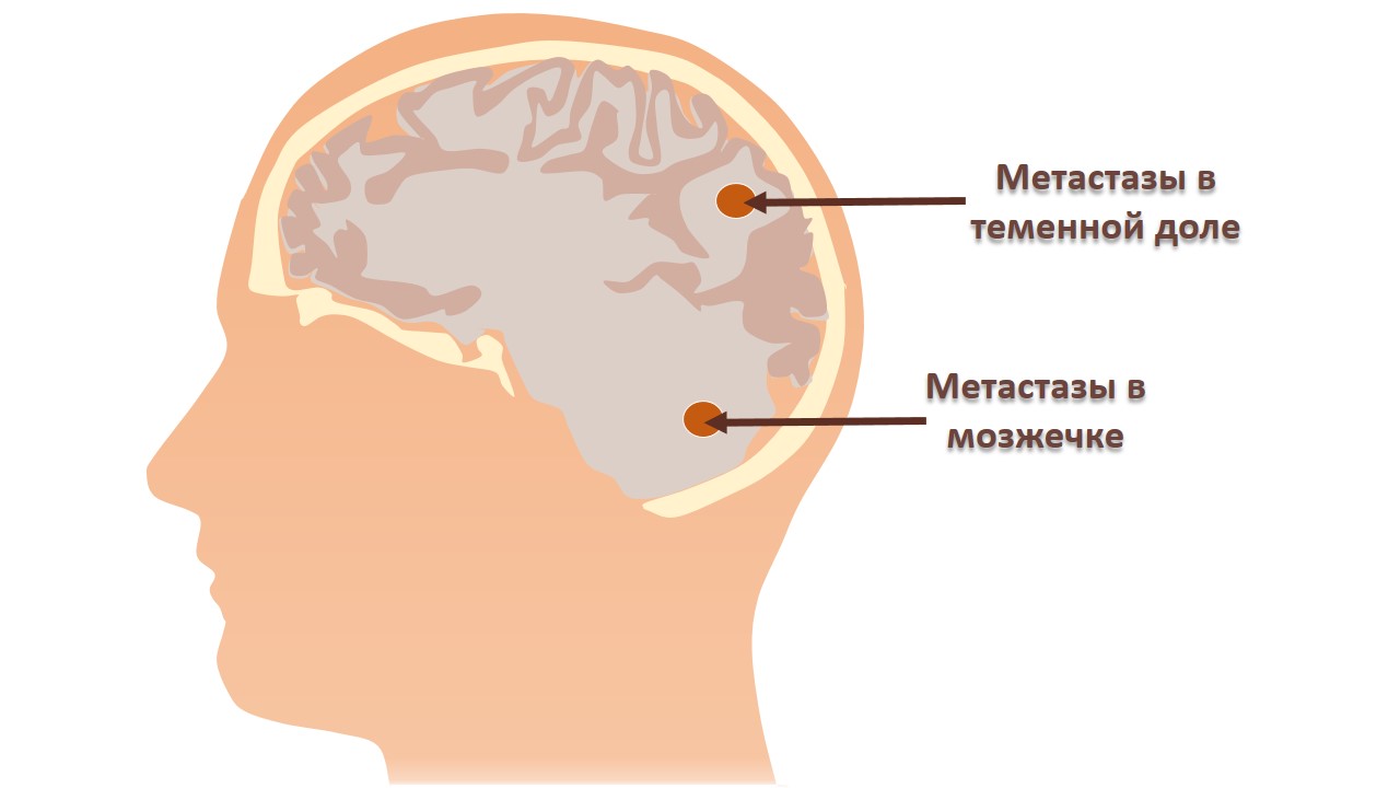 Лечение метастазов головного мозга в Германии — Симптомы и признаки  заболевания