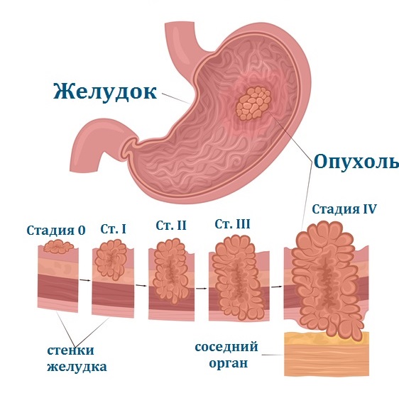 Рак желудка (аденокарцинома) – Лечение в Киеве – Симптомы