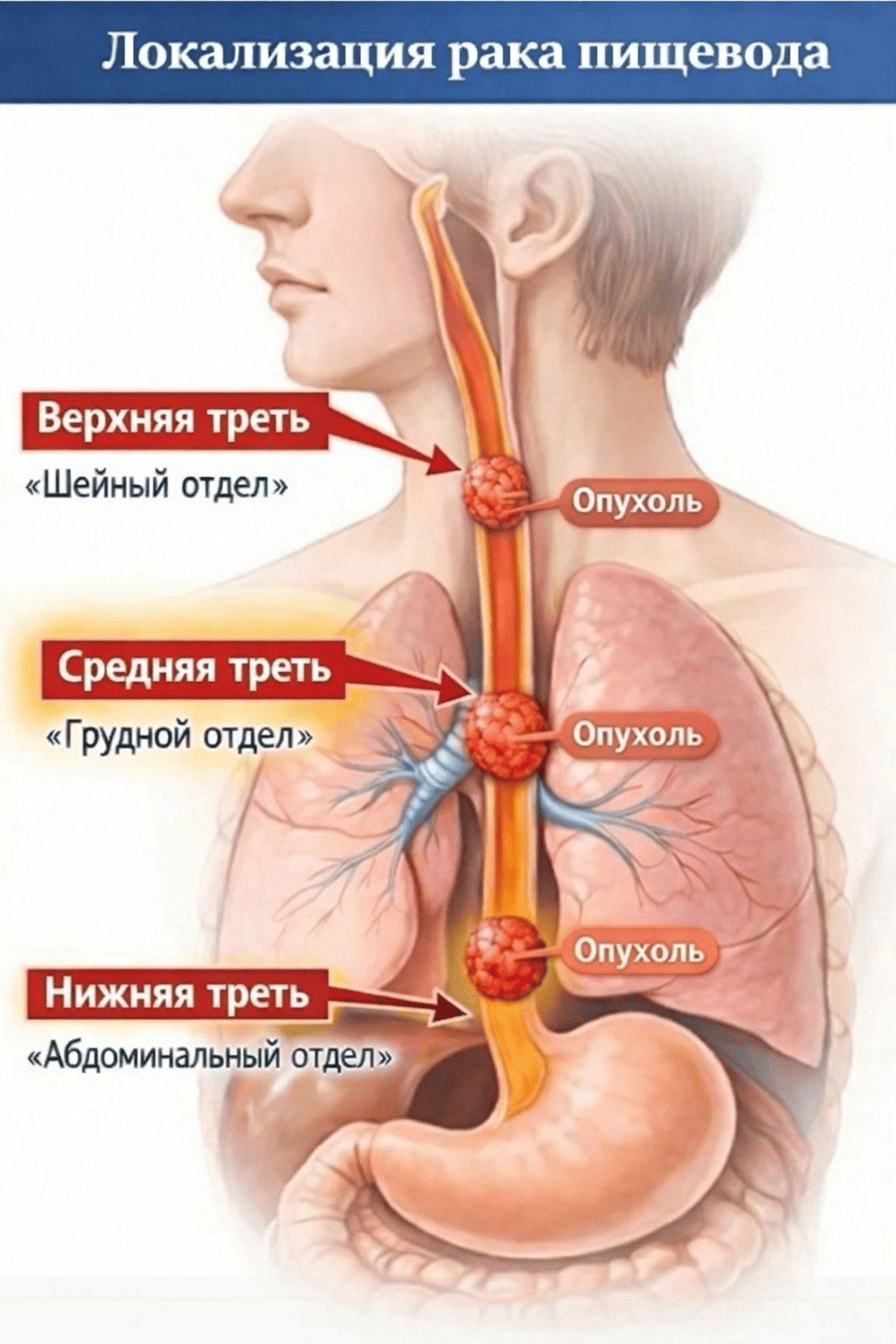 Влияние локализации опухоли на тактику лечения рака пищевода