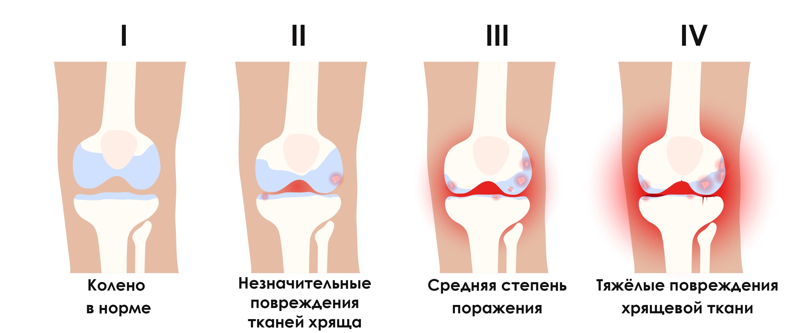 Деформирующий артроз коленного сустава (гонартроз)