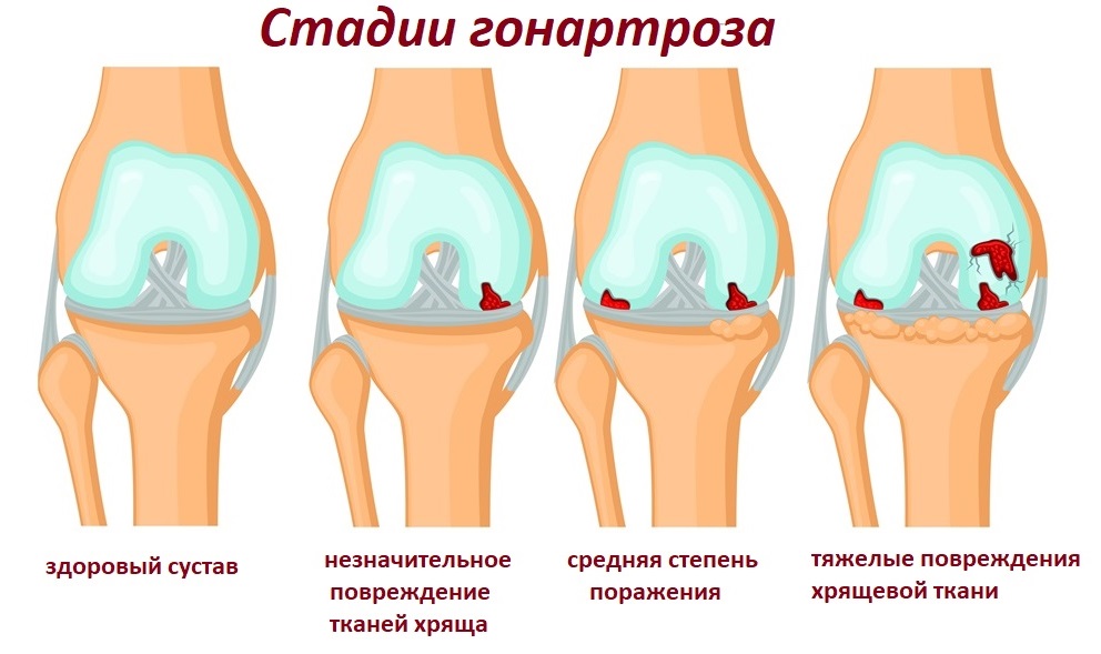 Что такое гонартроз (артроз коленного сустава)?