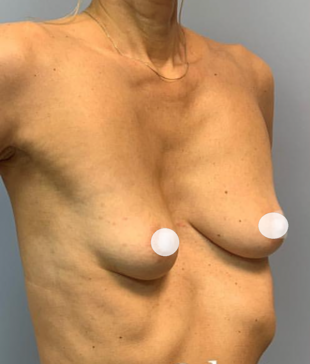воронкообразная грудь у женщин фото 11