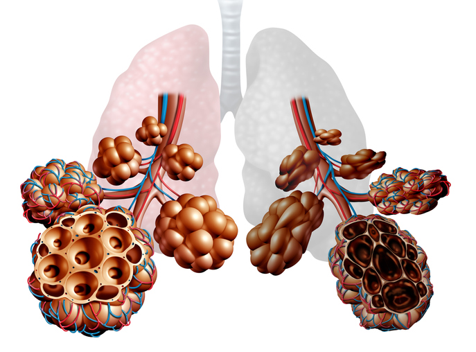 Эмфизема легких: лечение заболевания и методы профилактика — клиника «Добробут»