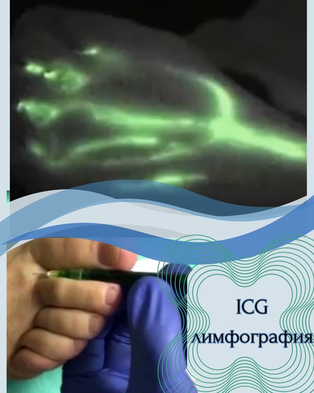Флуоресцентная диагностика ICG при диагностике лимфедемы в Германии